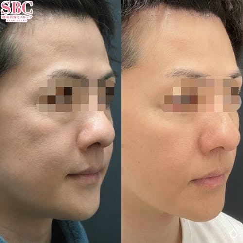 【男性・目元・顔】シークレットリフト、目の下の切らないクマ・たるみ（ふくらみ）取り、ナチュラル脂肪注射コンデンスリッチ_before_after