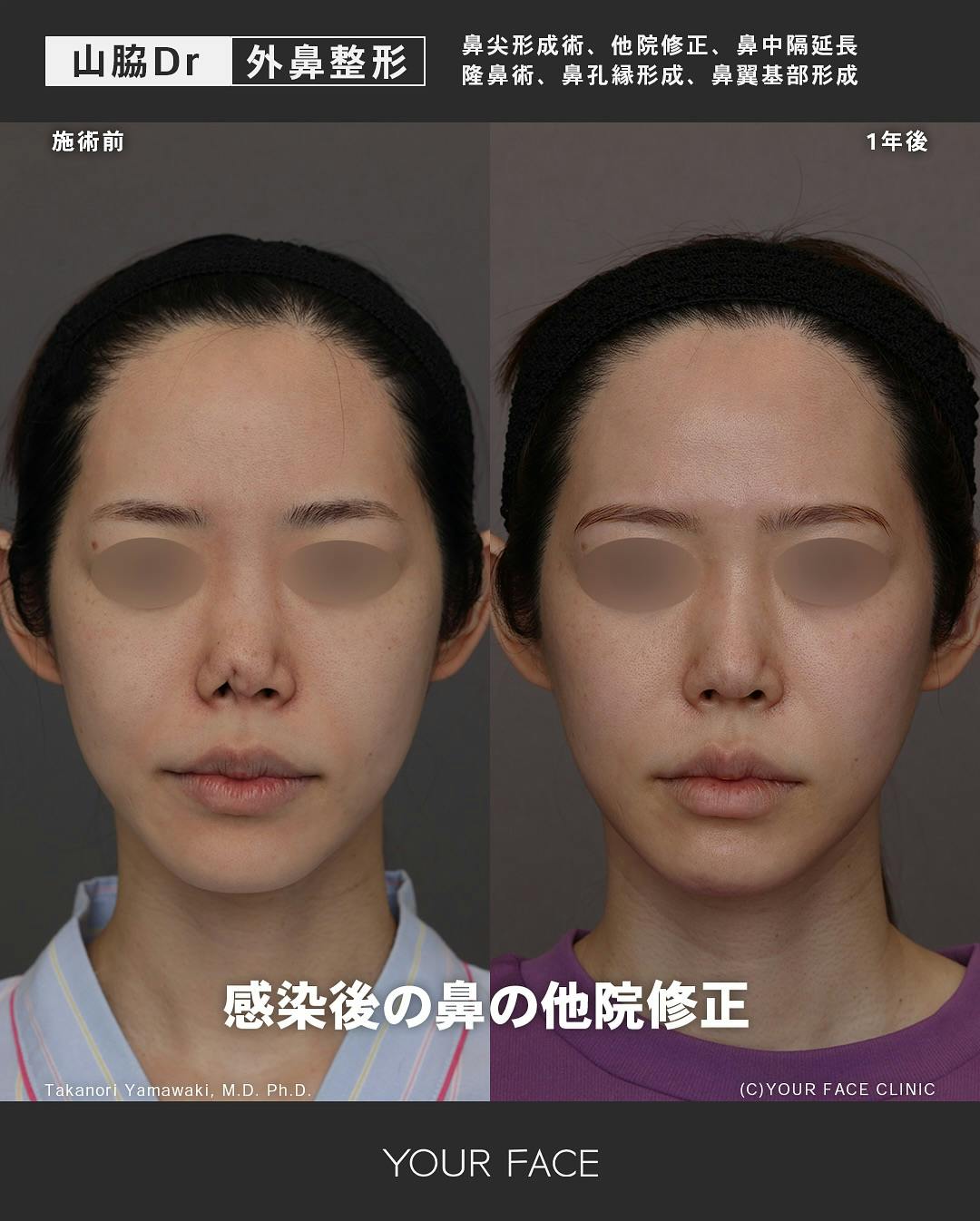 【女性・鼻】鼻尖形成術、他院修正、鼻中隔延長 隆鼻術、鼻孔縁形成、鼻翼基部形成_before_aftar