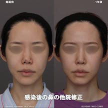 【女性・鼻】鼻尖形成術、他院修正、鼻中隔延長 隆鼻術、鼻孔縁形成、鼻翼基部形成_before_aftar