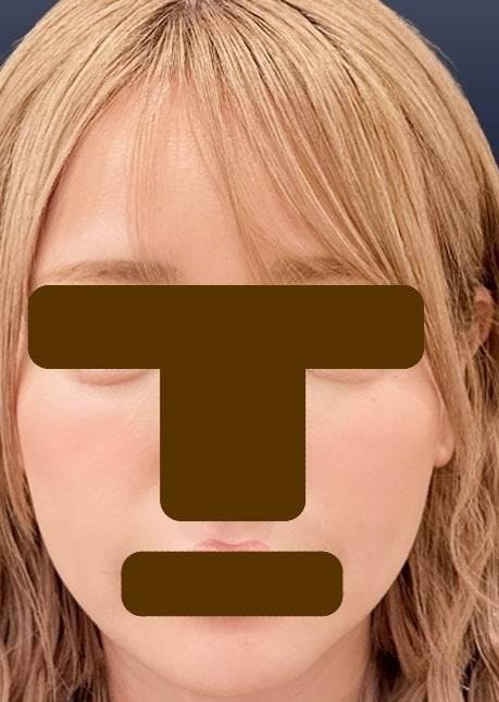ルラ美容クリニック 渋谷本院で糸リフト：ルラリフトを受けたゴツさんの写真