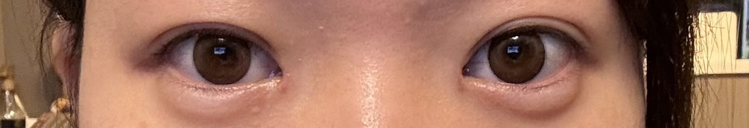 東京イセアクリニック(TOKYO ISEA CLINIC)で二重整形・目頭・蒙古ひだ切開を受けたななちさんの写真
