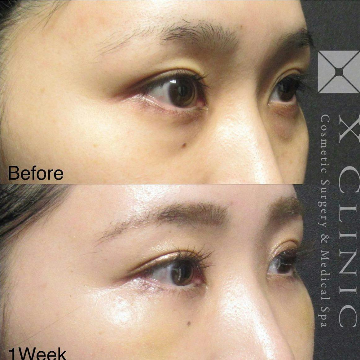 【女性・目元】クマ取りフルコース_before_aftar