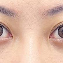 【女性・目元】目の下の切らないクマ・たるみ(ふくらみ)取り、ナチュラル脂肪注射コンデンスリッチ_after