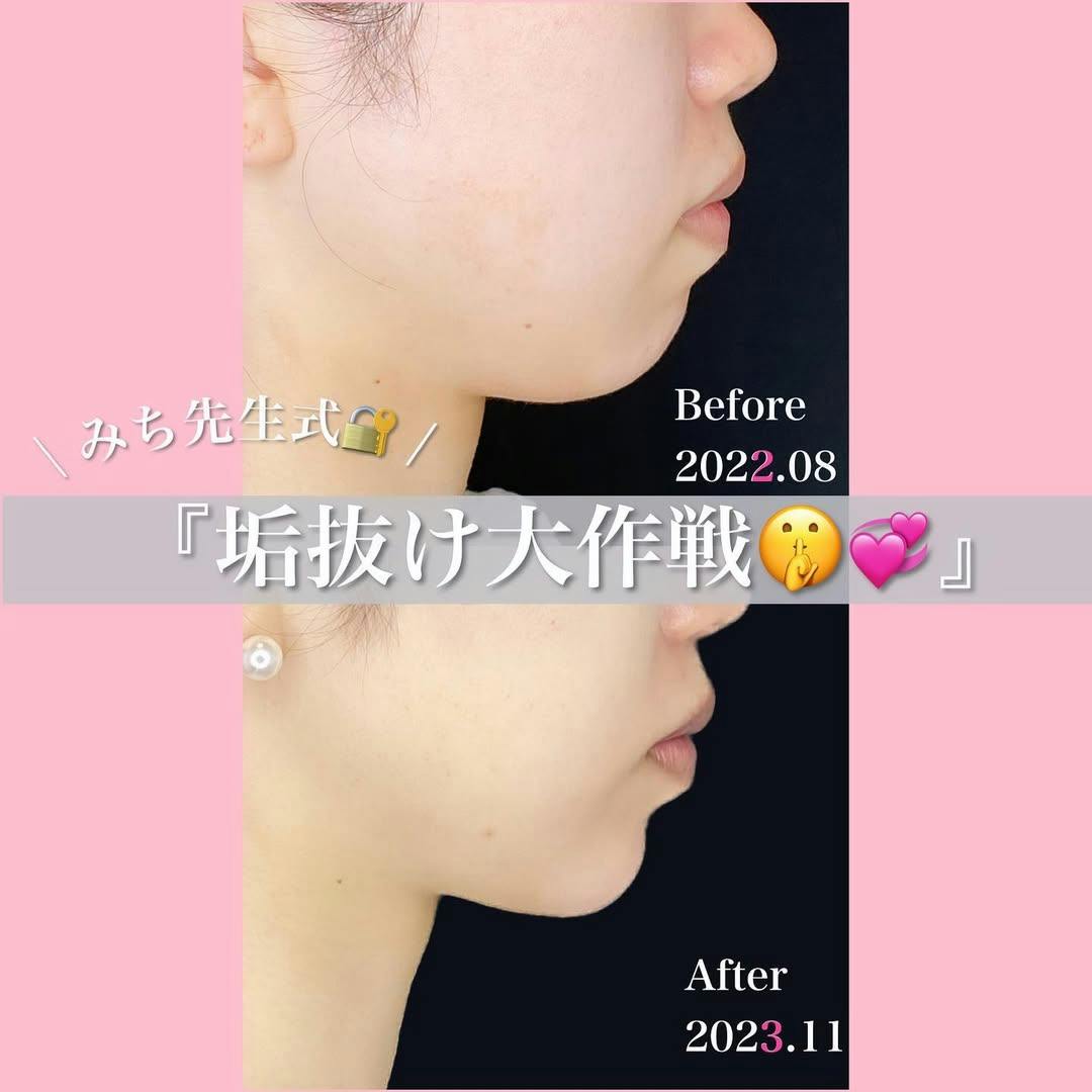 【女性・顔】脂肪溶解注射・サーマジェン・カスタマイズヒアル_before_aftar