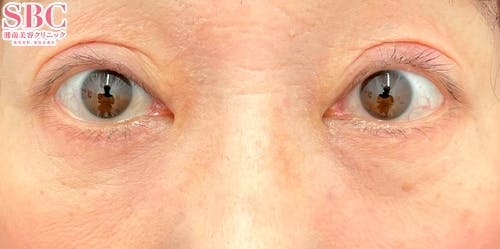 【目元】切開ハムラ(表ハムラ)法、ナチュラル脂肪注射ナノリッチ_after