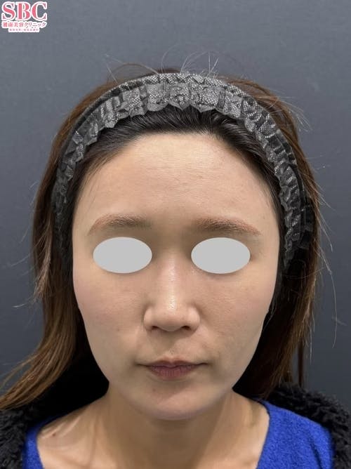 【30代女性・輪郭】ナチュラル脂肪注射コンデンスリッチ コンデンスリッチフェイス脂肪注入全顔入れ放題_after