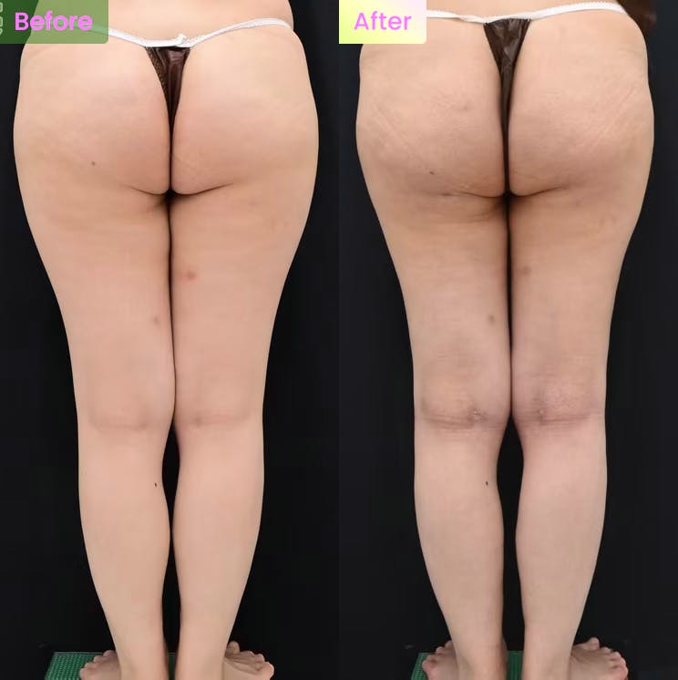 脂肪吸引・お尻の脂肪吸引・太ももの脂肪吸引・膝の脂肪吸引・ベイザー