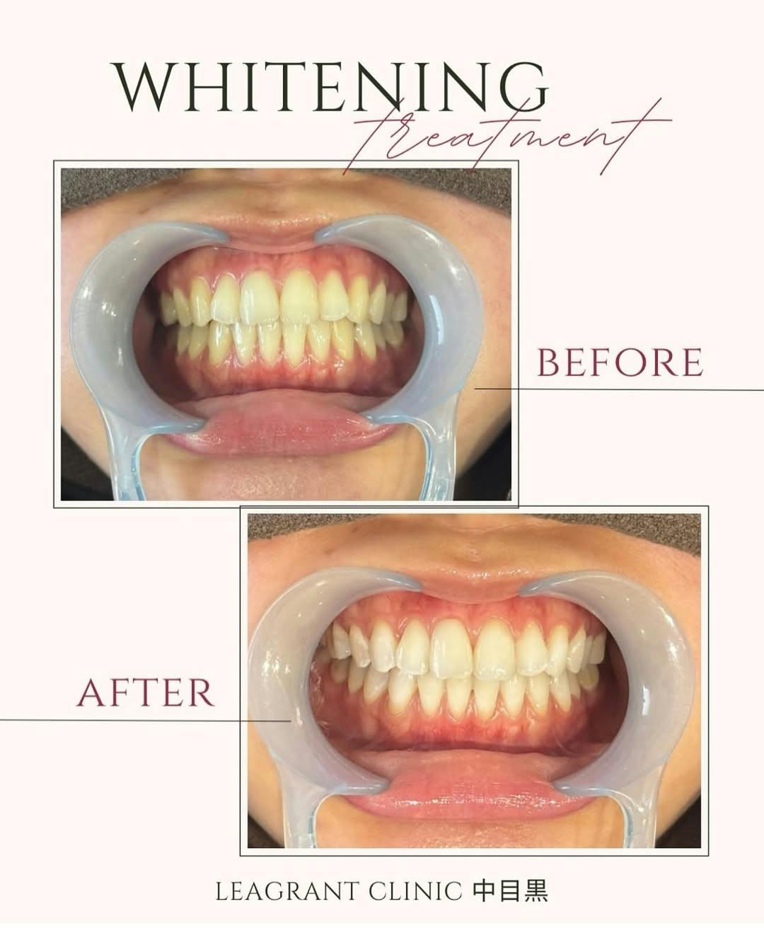 【20代女性・歯】ポリリンホワイトニング_before_aftar