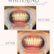 【20代女性・歯】ポリリンホワイトニング_before_aftar