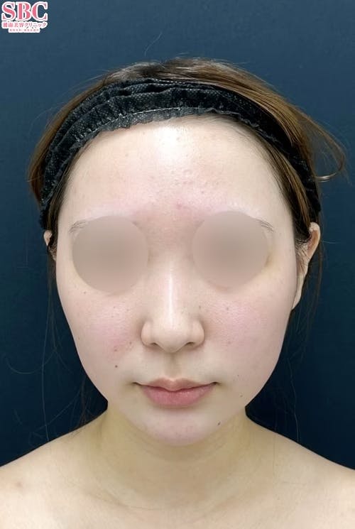 【20代女性・顔】小顔用脂肪吸引注射・糸リフト・その他の治療法_before