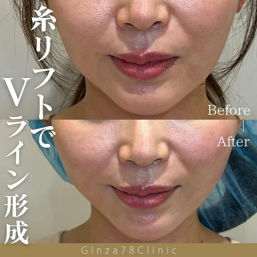 糸リフト(スレッドリフト)の症例写真・ビフォーアフター画像No.629