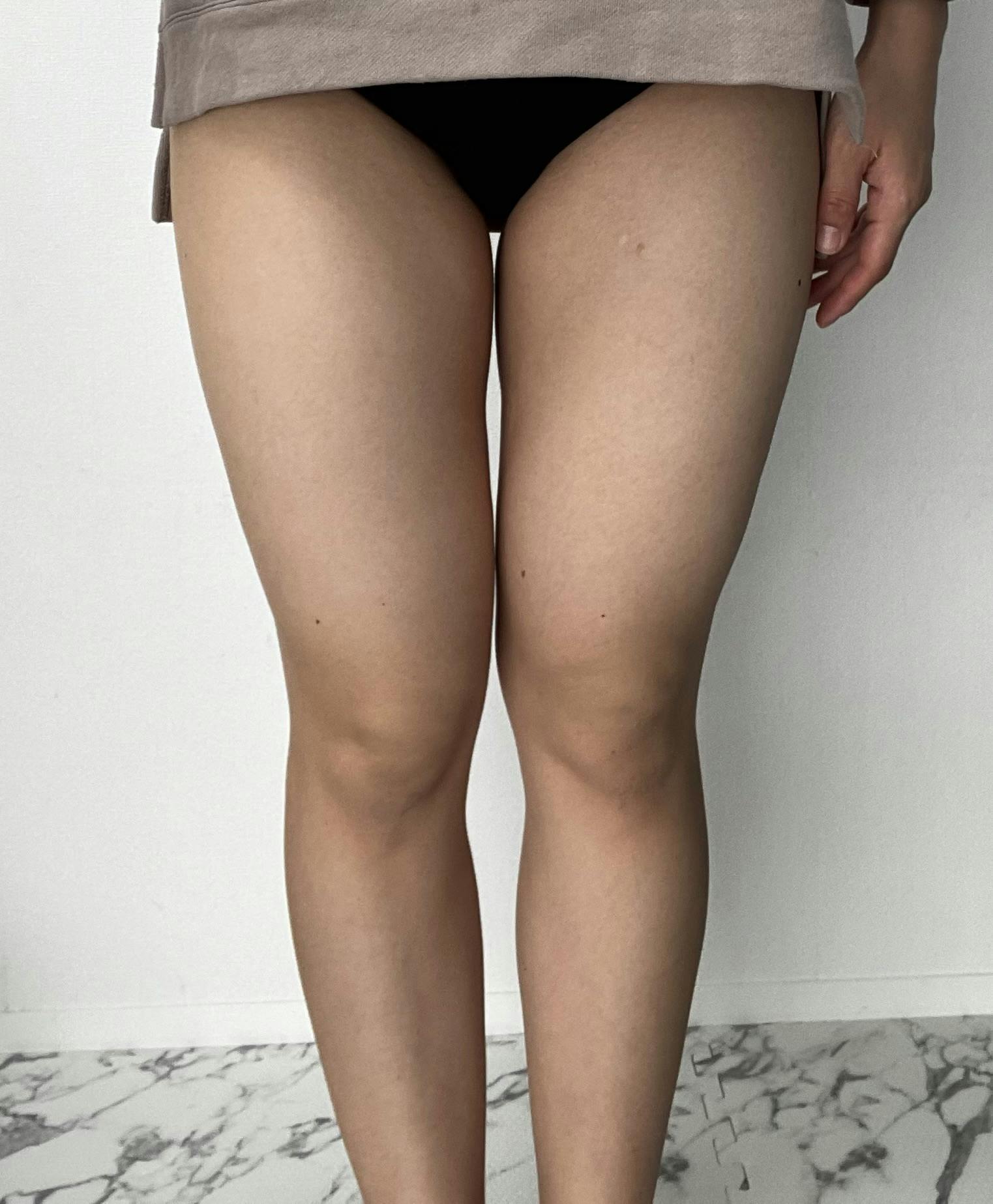 湘南美容クリニック 町田院でを受けたゆいさんの写真
