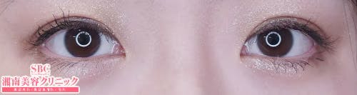 【女性・目元】クイックコスメティーク・シングルNeo、クイックコスメティーク・ダブルNeo、埋没法二重術クイックコスメティーク法_after