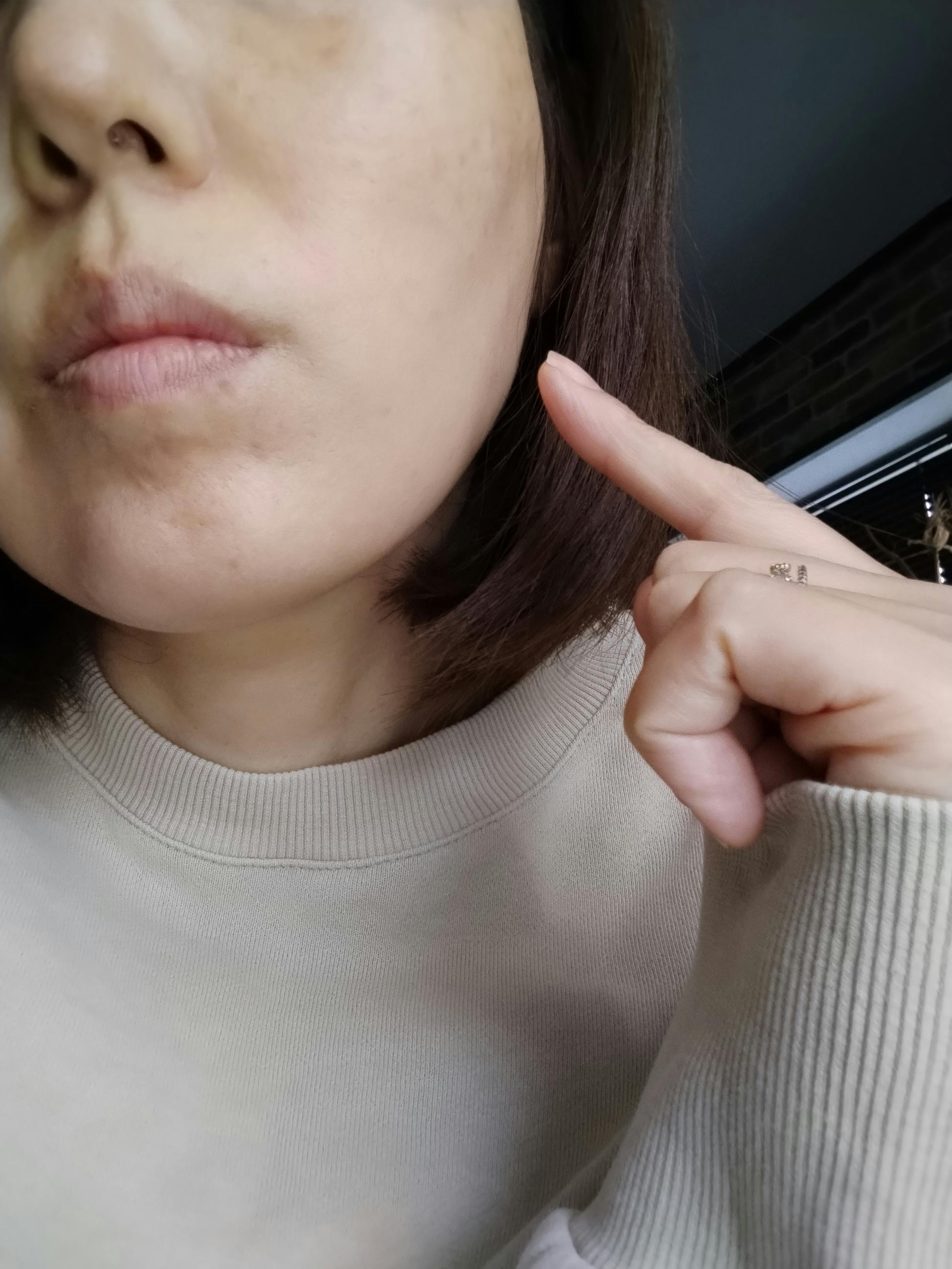 湘南美容クリニック 町田院でを受けたジャスミンさんの写真