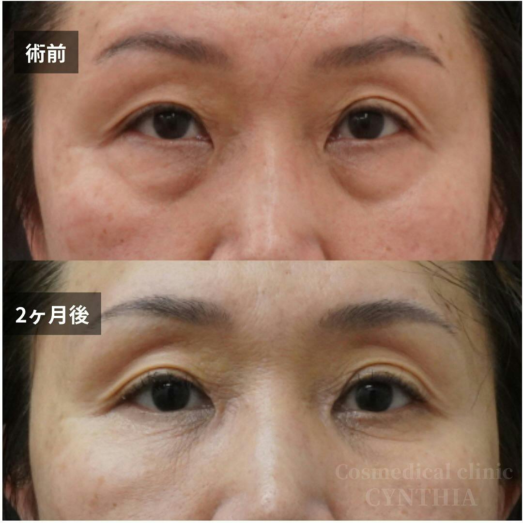 【50代女性・目元】経結膜脱脂術・眼窩脂肪注入_before_aftar