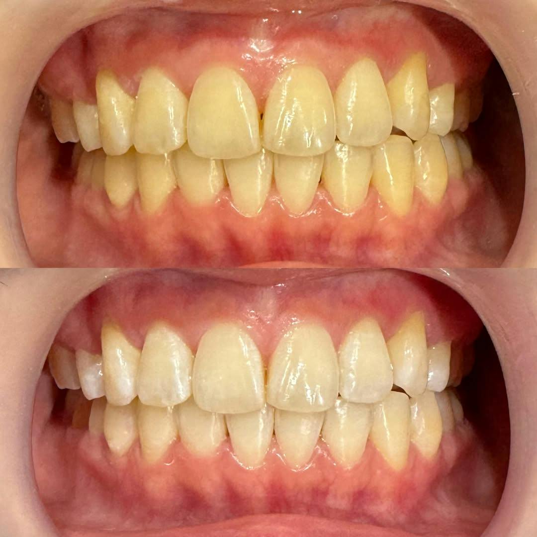 【歯】ホワイトニング_before_aftar
