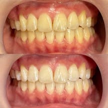 【歯】ホワイトニング_before_aftar
