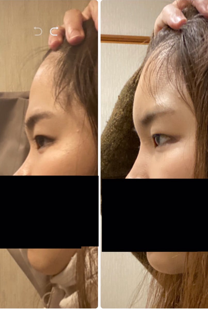 恵聖会クリニック 京橋院でヒアルロン酸注入（額・鼻筋）を受けた山藤さんの写真