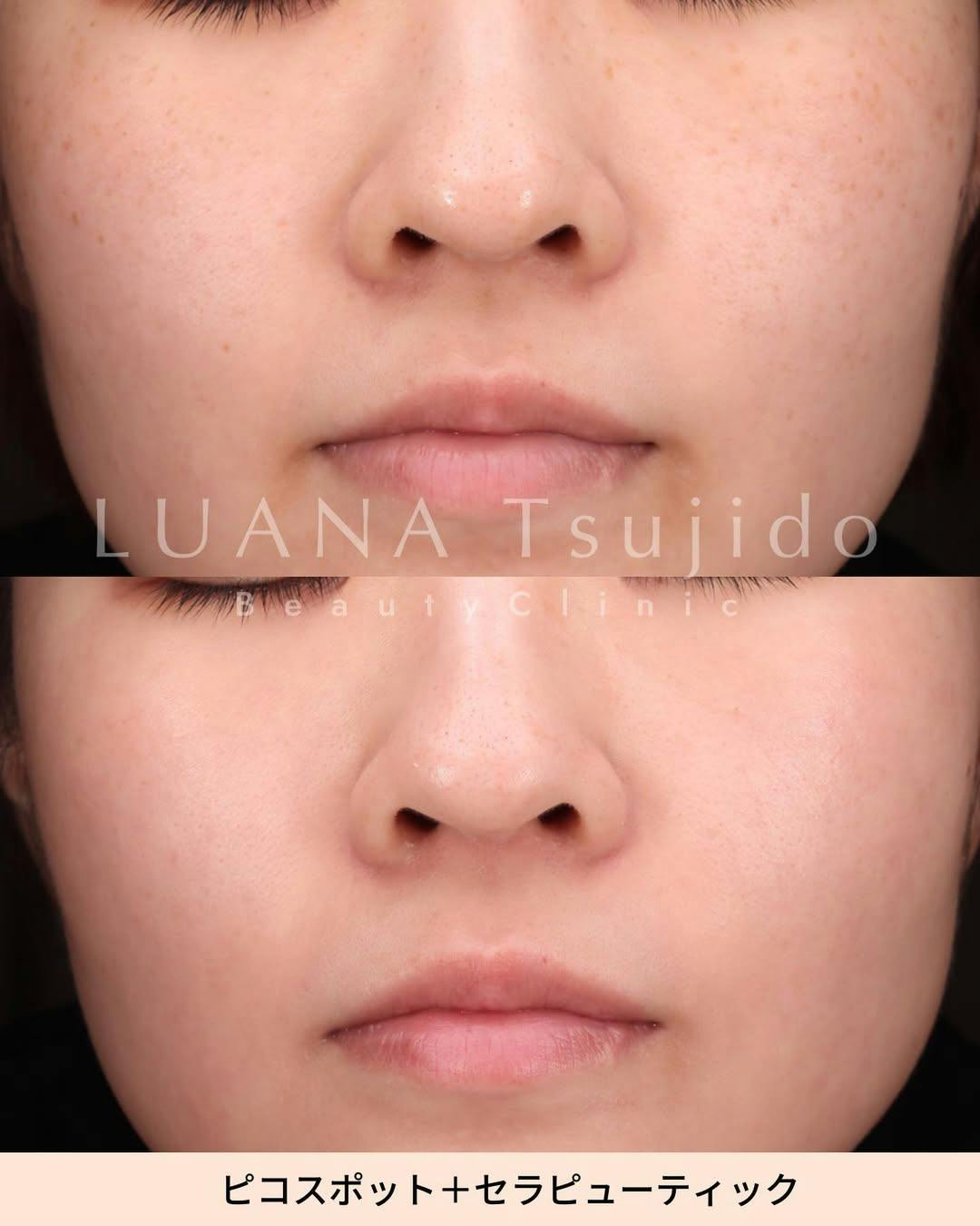 【女性・顔】ピコスポット＋セラピューティック(ガウディスキン)_before_aftar
