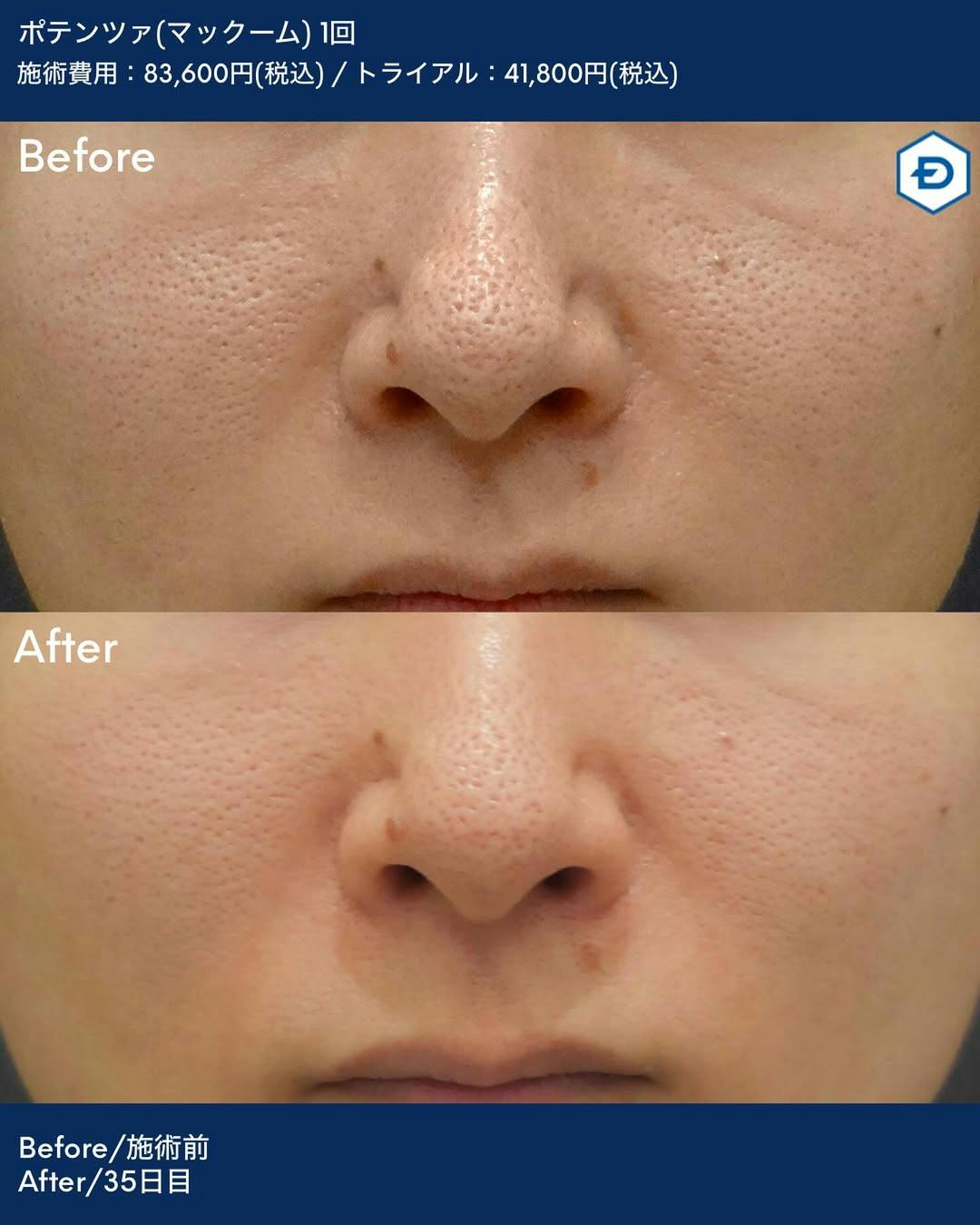 【男性・毛穴】ポテンツァ(マックーム)_before_aftar