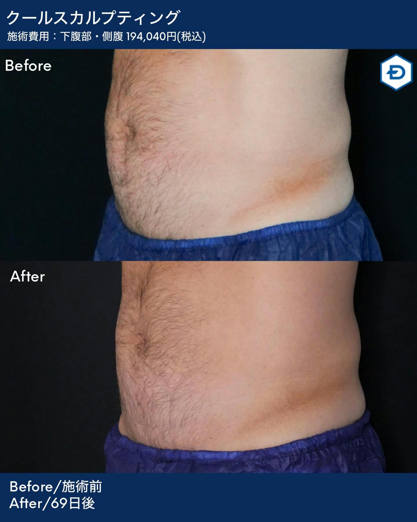 【男性・腹部】クールスカルプティング 下腹部・側腹_before_aftar