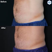 【男性・腹部】クールスカルプティング 下腹部・側腹_before_aftar