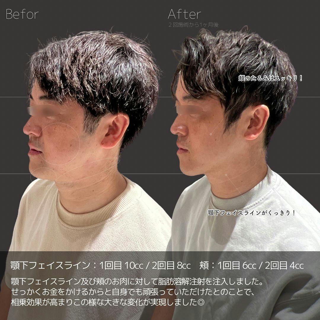 【男性・輪郭】FatX core_before_aftar