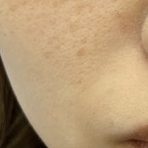 【女性・ほうれい線】シークレットリフト・VOV(ボブ)リフト・ヒアルロン酸ジュビダームビスタ バイクロスシリーズ_after