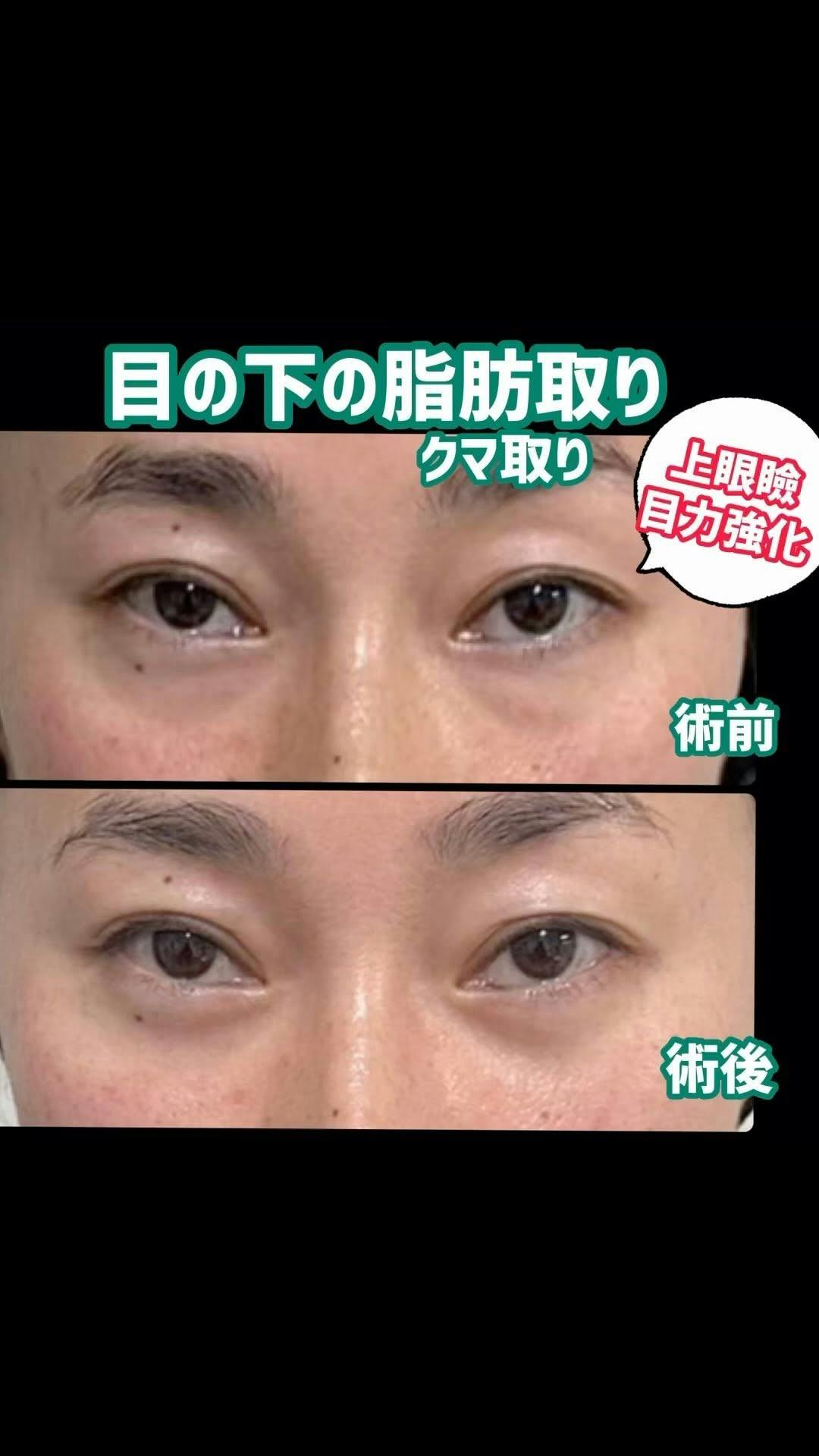 【クマ】目の下の脂肪取り術_before_aftar