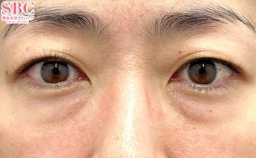 【40代女性・クマ】目の下の切らないクマ・たるみ（ふくらみ）取り、ナチュラル脂肪注射ナノリッチ、ナチュラル脂肪注射コンデンスリッチ_before