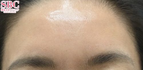 【女性・額・眉間】女優注射(R)~リジュランi＋ボトックス~_after