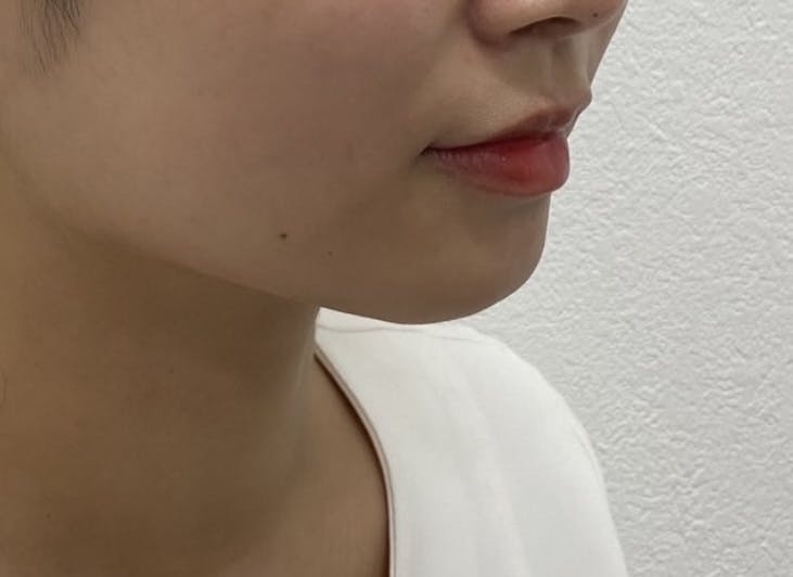 TCB東京中央美容外科 自由が丘院で顎のヒアルロン酸を受けたAさんの写真