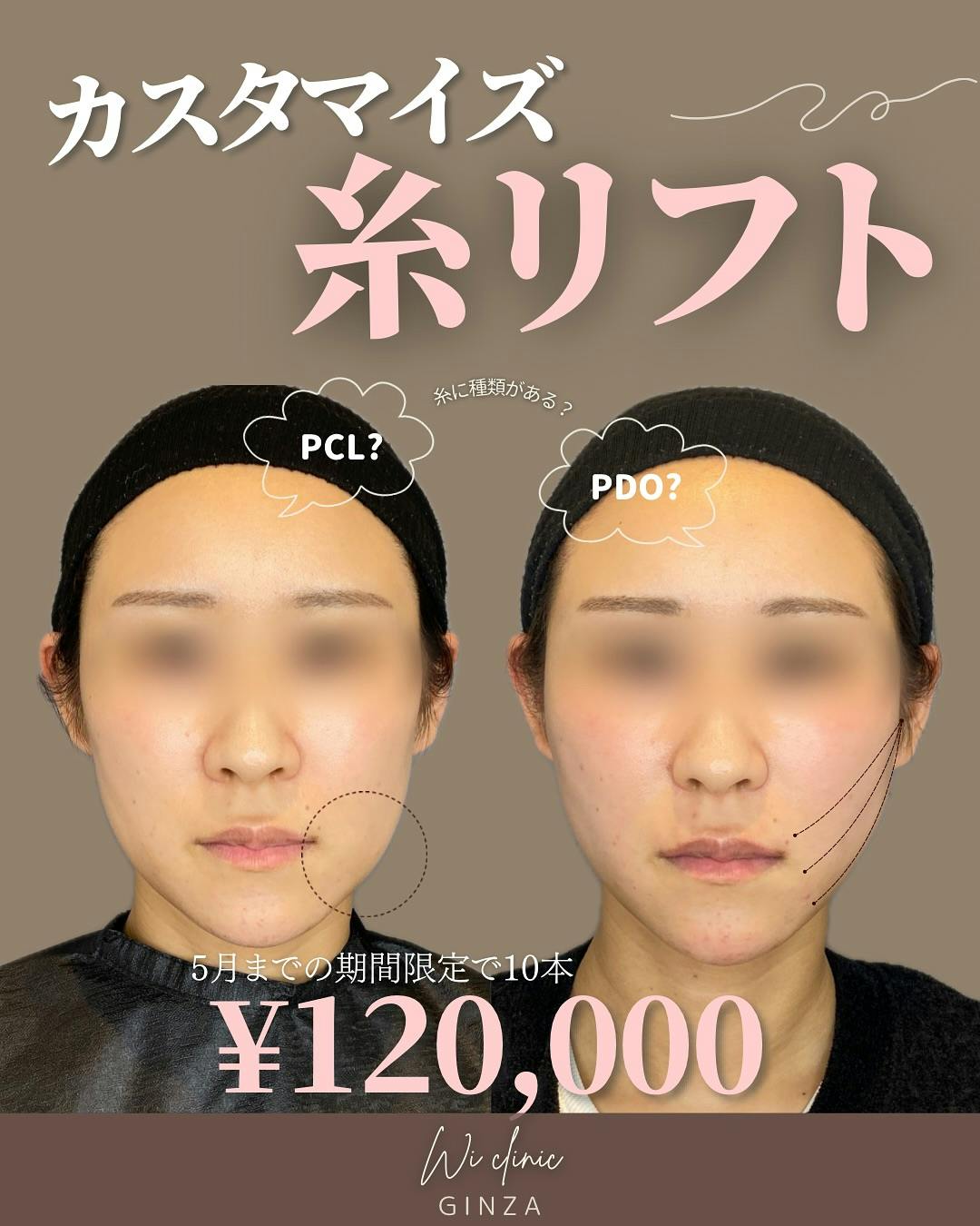 【30代女性・法令線】糸リフト_before_aftar