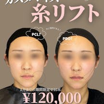 【30代女性・法令線】糸リフト_before_aftar