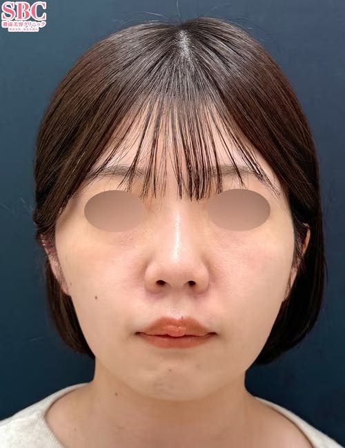 【20代女性・顔】Aquicell(アキーセル)脂肪吸引・根こそぎVASER脂肪吸引・ジョールファット除去術・VOVリフト_after