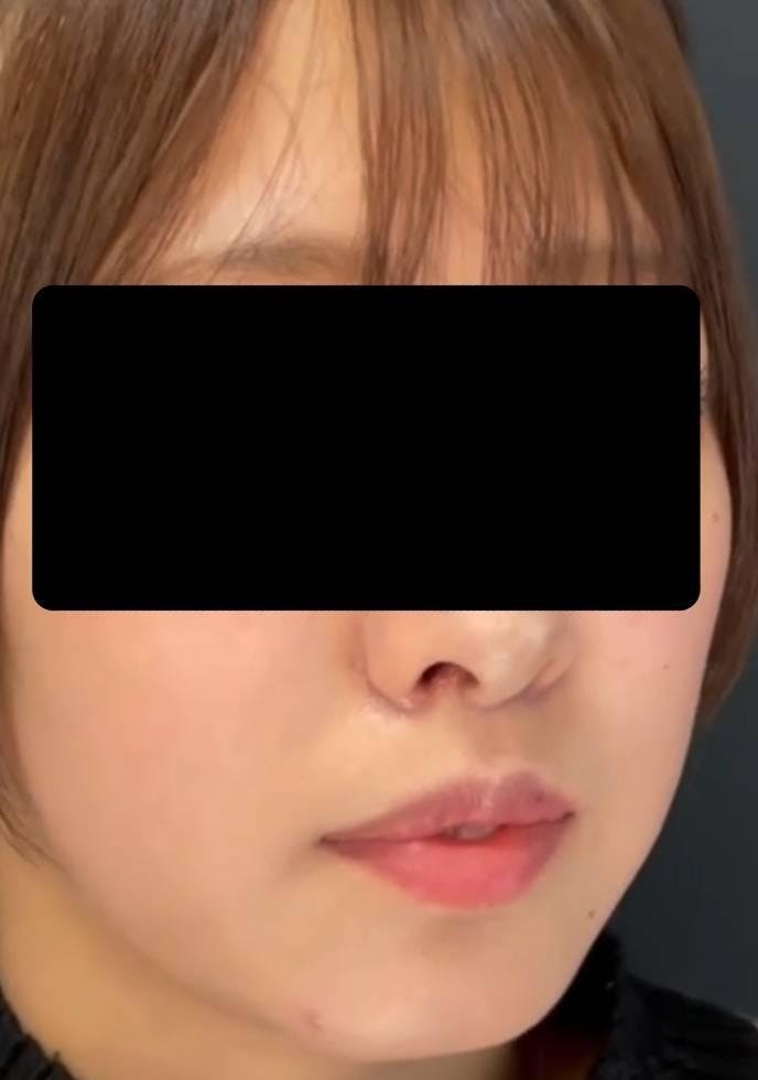 ルラ美容クリニック 渋谷本院で口元・唇の整形：人中短縮術を受けた葵さんの写真