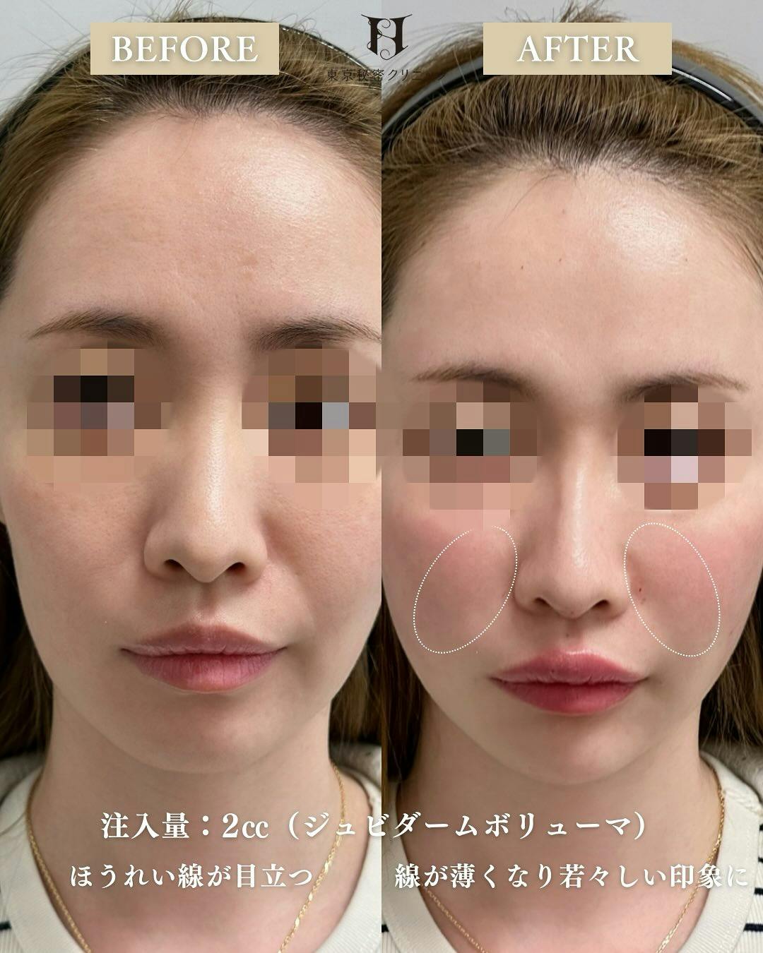 【女性・ほうれい線】ヒアルロン酸（ほうれい線）_before_aftar