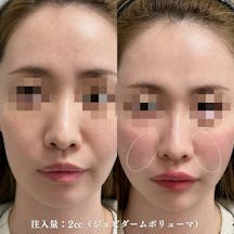 【女性・ほうれい線】ヒアルロン酸(ほうれい線)_before_aftar