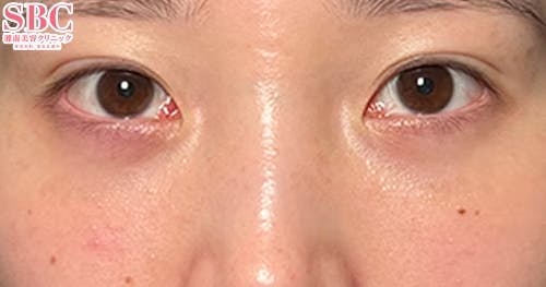 【20代・クマ】目の下の切らないクマ・たるみ（ふくらみ）取り、ナチュラル脂肪注射コンデンスリッチ、ナチュラル脂肪注射ナノリッチ_1month