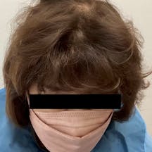 【65歳女性・頭髪】薄毛治療_after