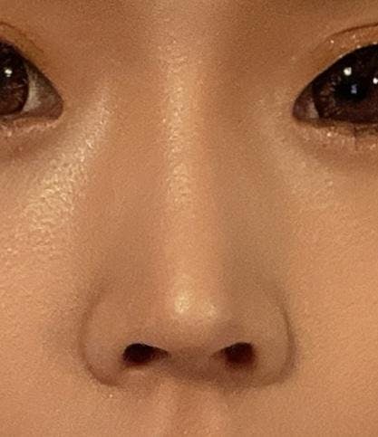 城本クリニック福岡院で鼻ヒアルロン酸を受けたりりさんの写真