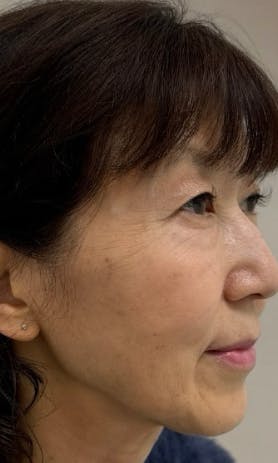 【50代女性・フェイスライン】アルテミスリフト_a1