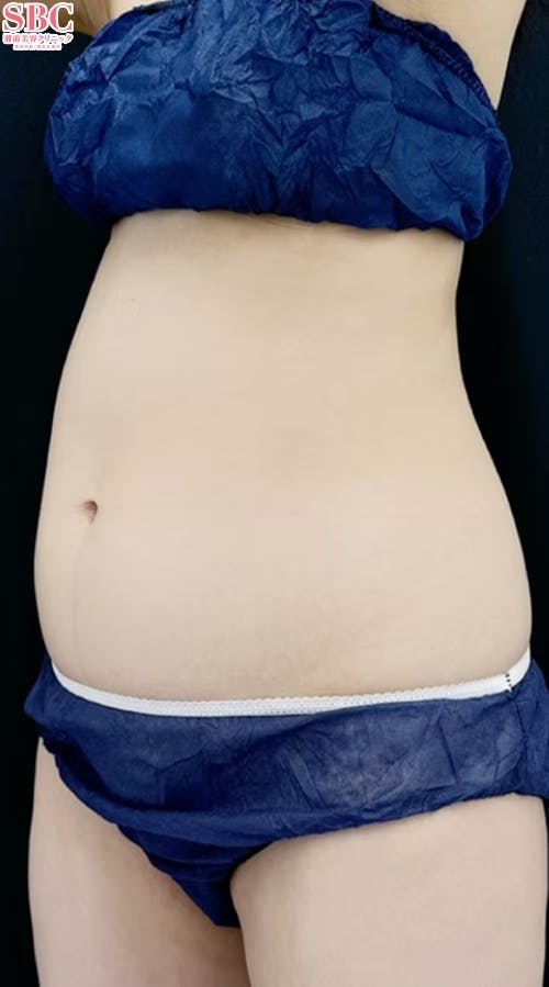 【20代女性・腹部】クールスカルプティング(R)・ エリート（クルスカダブル）_before