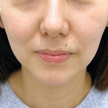 【女性・輪郭】テスリフト VOV(ボブ)リフト シークレットリフト_before