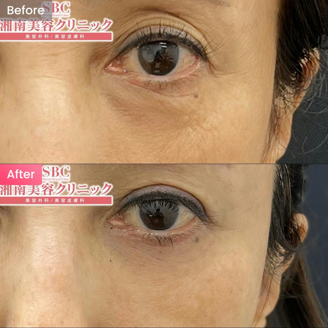 目の下のクマ・たるみ取り・ボトックス注射・リジュラン注射(高濃度サーモン注射)・リジュランアイ・アラガン製ボトックス・クマ取り注射 ・スキンブースター・リジュランHB・目元整形の症例写真・ビフォーアフター画像No.5275 | 湘南美容クリニック 自由が丘院, image size:1250x1250