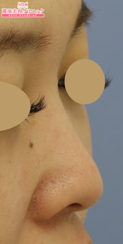 【女性・鼻】SBCプレミアムソフトプロテーゼ_before