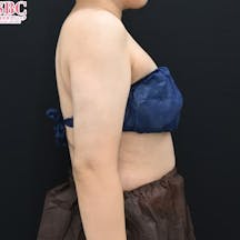 【30代女性・二の腕】Aquicell(アキーセル)脂肪吸引・根こそぎVASER脂肪吸引_aftar