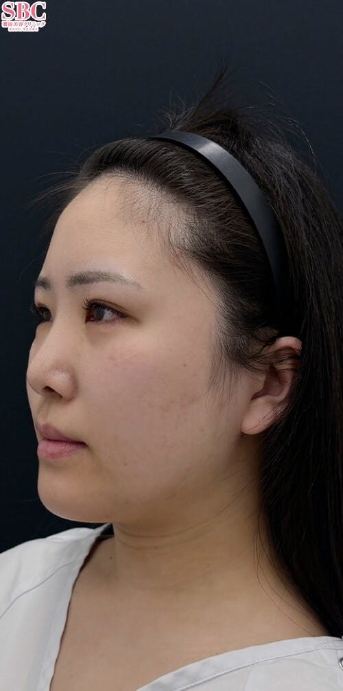 【20代女性・たるみ】ナチュラル脂肪注射コンデンスリッチ、ナチュラル脂肪注射ナノリッチ_before