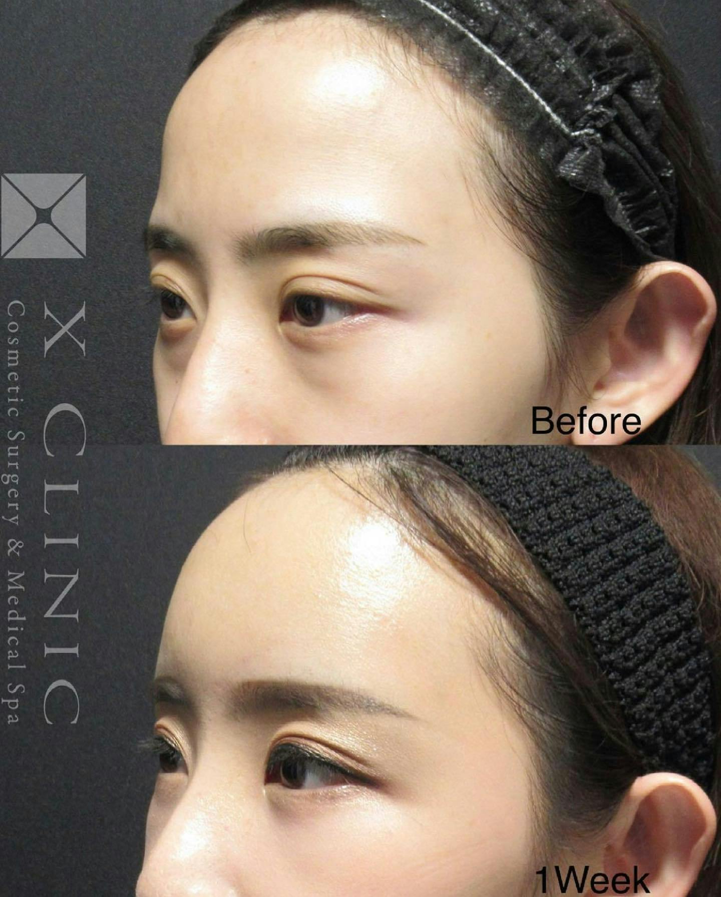 【女性・目元】クマ取りフルコース 額こめかみ脂肪注入_before_aftar