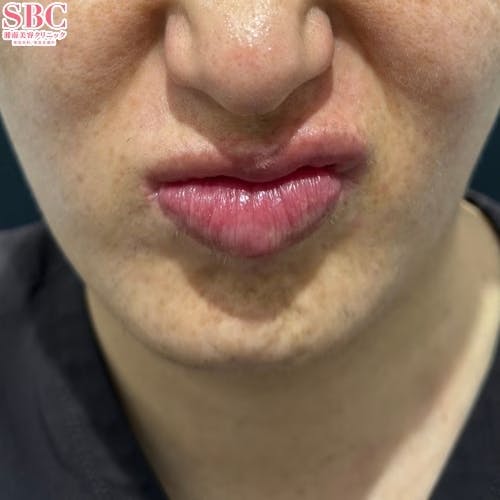 【しわ】ボトックス（アラガン）_before